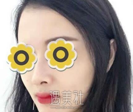 黄金龙，隆鼻