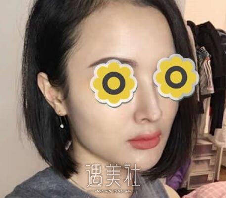黄金龙，隆鼻