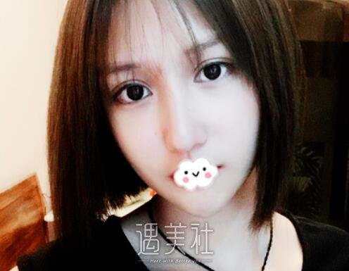 姜洪涛双眼皮