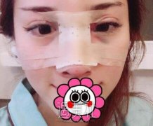 刘彦军隆鼻案例：和我五官特别的相配 width=