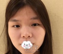 刘育凤案例双眼皮：就跟变了一个人似的 width=