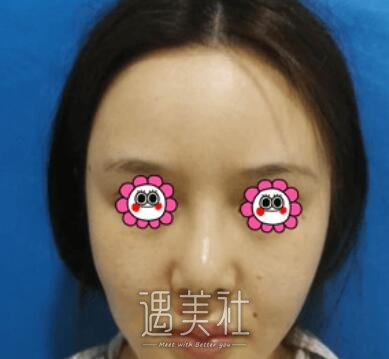 南京,李俊,隆鼻