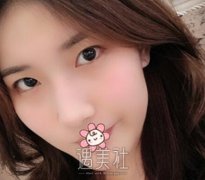 刘育凤双眼皮案例:一双眼睛可以改变一个人 width=