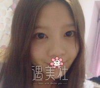 佛山华美雷朝勇隆鼻案例：提升了气质和颜值~ width=