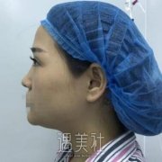 福州张胜利隆鼻案例：鼻梁高挺又秀气~ width=