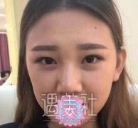 金孝宪鼻修复做得怎么样？亲身改变过程图一览 width=