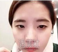 靳小雷双眼皮案例：和自己预想竟然差不多！ width=