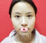 李斌斌隆鼻案例：术后五官显得更加洋气~ width=