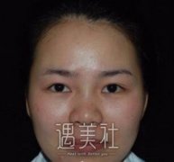 李敏双眼皮案例：我也算是个时尚女郎啦！ width=