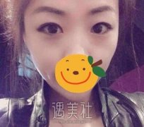 刘菲双眼皮案例：现在的眼睛炯炯有神~ width=