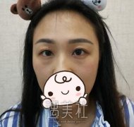 华西卿勇去眼袋技术怎么样？有案例吗？ width=