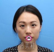 王琪影做的双眼皮案例：趁年轻早变美~ width=