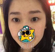 西安孙峰双眼皮案例：气质上升了不少呢~ width=