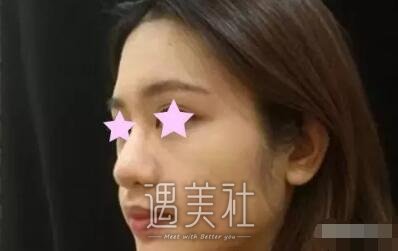 301医院韩岩隆鼻案例|原来他的实力是这样子的!