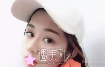 301医院韩岩隆鼻案例|原来他的实力是这样子的!
