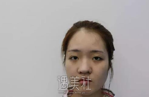 八大处王克明隆鼻案例|就此改变人生!