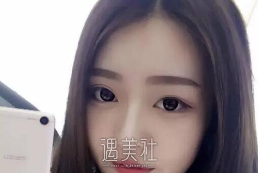八大处王克明隆鼻案例|就此改变人生!