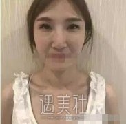 北京王军隆鼻案例|果很夸张! width=