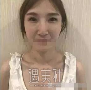 北京王军隆鼻案例|果很夸张!