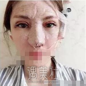 北京王军隆鼻案例|果很夸张!