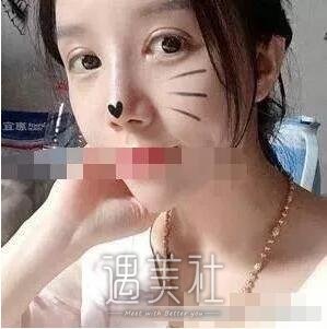 北京王军隆鼻案例|果很夸张!