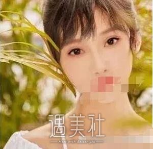 北京王军隆鼻案例|果很夸张!
