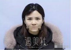 曹海峰隆鼻案例|果让我较为满意! width=