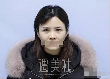 曹海峰隆鼻案例|果让我较为满意!