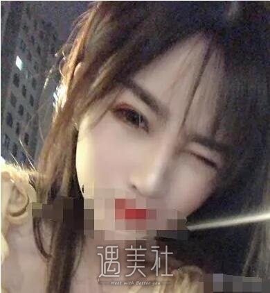 曹海峰隆鼻案例|果让我较为满意!