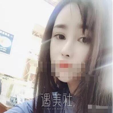 曹海峰隆鼻案例|果让我较为满意!