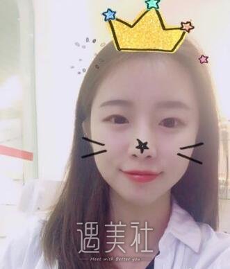 曹阳双眼皮案例|从此就能美美哒!