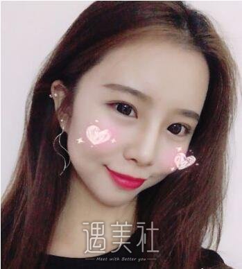 曹阳双眼皮案例|从此就能美美哒!