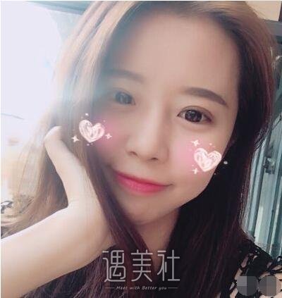 曹阳双眼皮案例|从此就能美美哒!