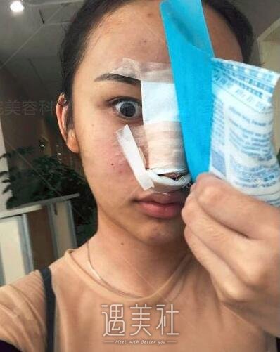 陈天杰隆鼻案例|真能想要果吗?
