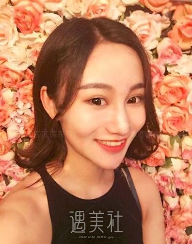 陈天杰隆鼻案例|真能想要果吗?