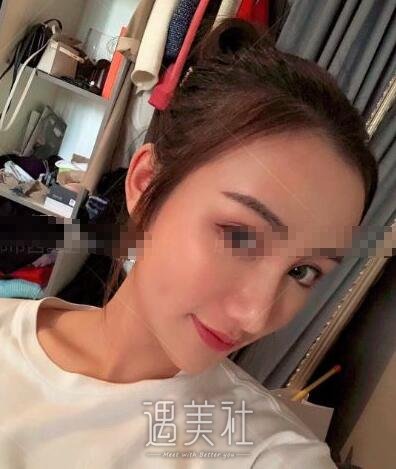陈天杰隆鼻案例|真能想要果吗?