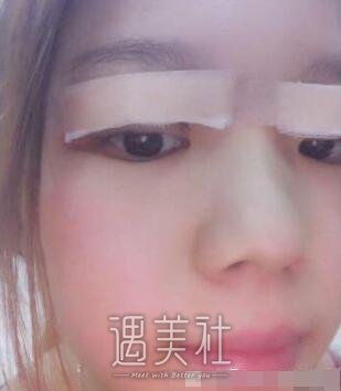 陈振宇双眼皮案例|果很真实!