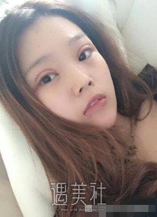 陈振宇双眼皮案例|果很真实!