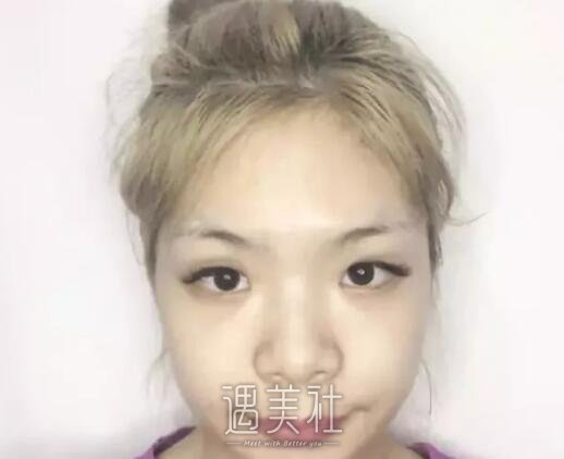 陈芝双眼皮案例|术后心情美美哒!