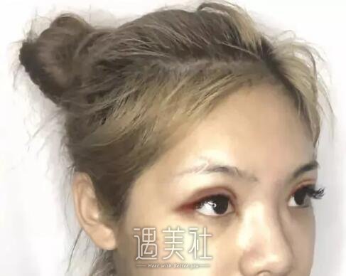 陈芝双眼皮案例|术后心情美美哒!