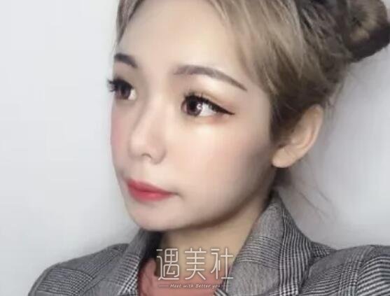 陈芝双眼皮案例|术后心情美美哒!