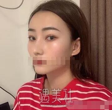 杨亚益双眼皮案例|终于能变成想要模样了!