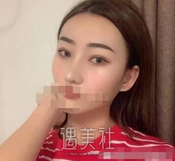 杨亚益双眼皮案例|终于能变成想要模样了!