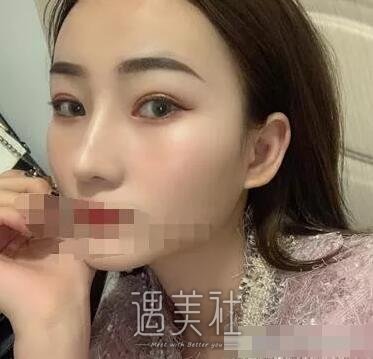 杨亚益双眼皮案例|终于能变成想要模样了!