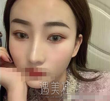 杨亚益双眼皮案例|终于能变成想要模样了!