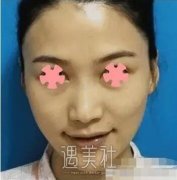 尤建军隆鼻案例展示|果真是太好了! width=