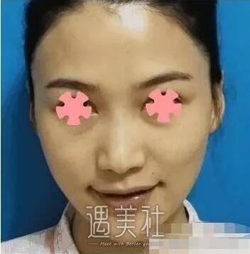 尤建军隆鼻案例展示|果真是太好了!