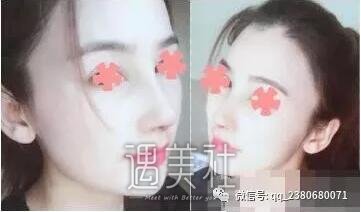 尤建军隆鼻案例展示|果真是太好了!