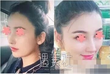 尤建军隆鼻案例展示|果真是太好了!