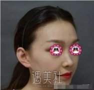 游晓波隆鼻案例分享|颜值瞬间提升好几倍! width=
